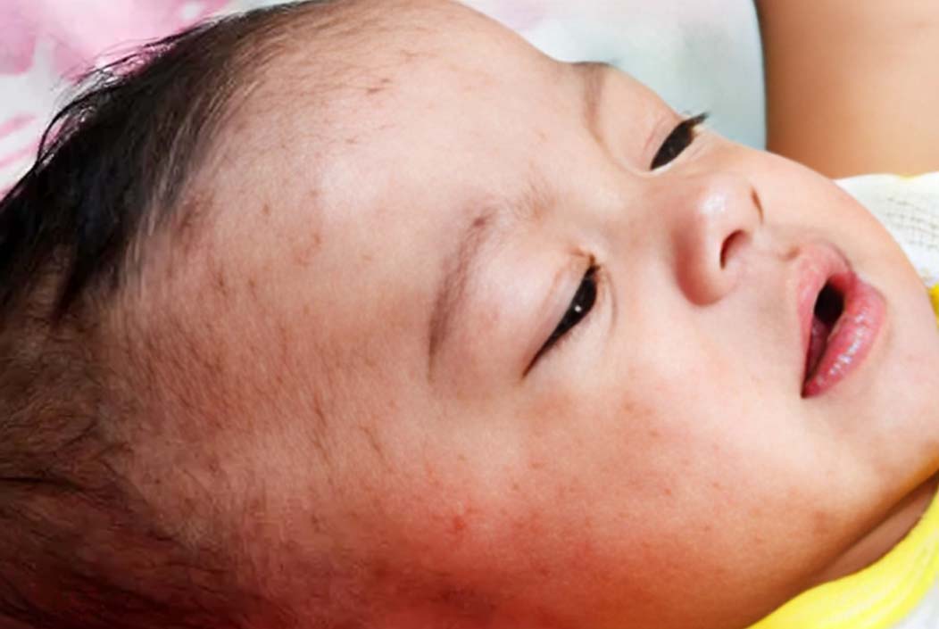 Measles infections on the rise in Barguna, 18 children infected Onnetion